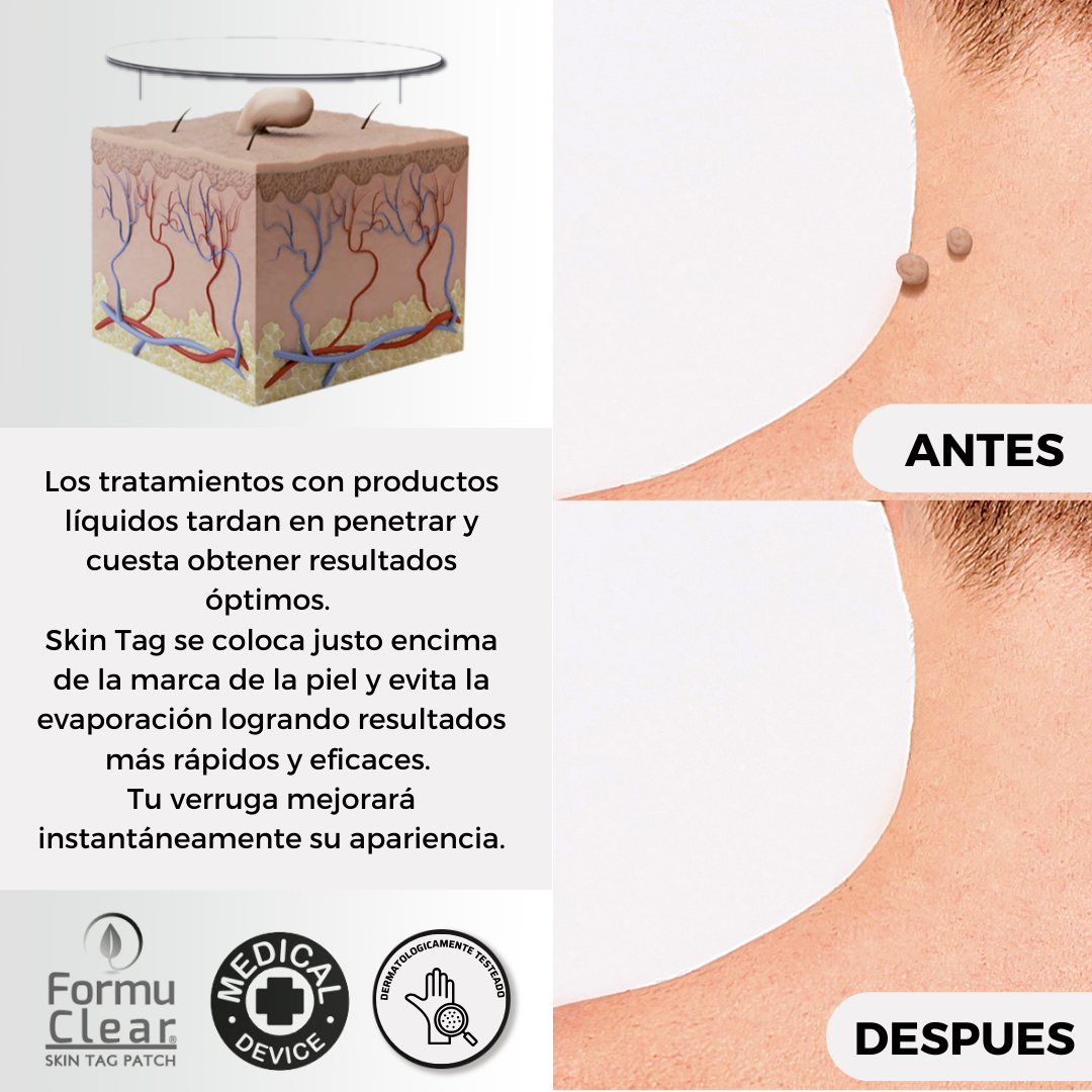 ELIMINA VERRUGASFormu Clear Skin Tag