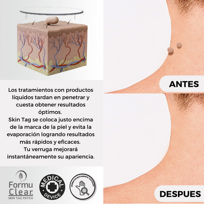ELIMINA VERRUGASFormu Clear Skin Tag